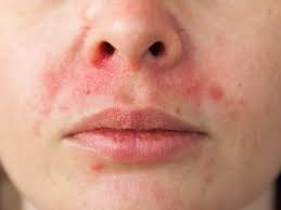Dermatitis Perioral